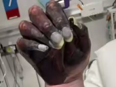 Mãe morre após amputação do braço enquanto médicos descartam mão enegrecida como ‘tinta de jornal’