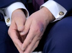Casa Branca explica hematoma na mão de Trump