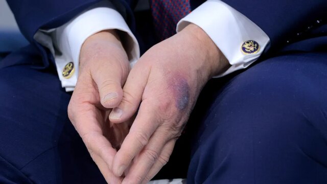 trump-bruise-hand.jpg