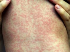 Surto de sarampo na Carolina do Sul está associado a inchaço cerebral em crianças