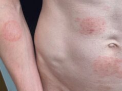 Um fungo sexualmente transmissível está se tornando aconchegante nos EUA