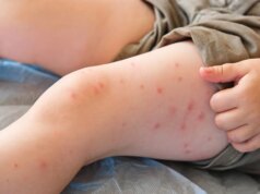 Surto de sarampo representa risco de danos cerebrais “irreversíveis”, alertam autoridades de saúde