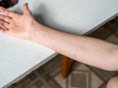 Maior surto de sarampo da história recente relatado no campus universitário do sudoeste