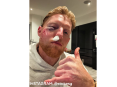 Stokes saiu com um enorme olho roxo após ser atingido por uma bola de críquete